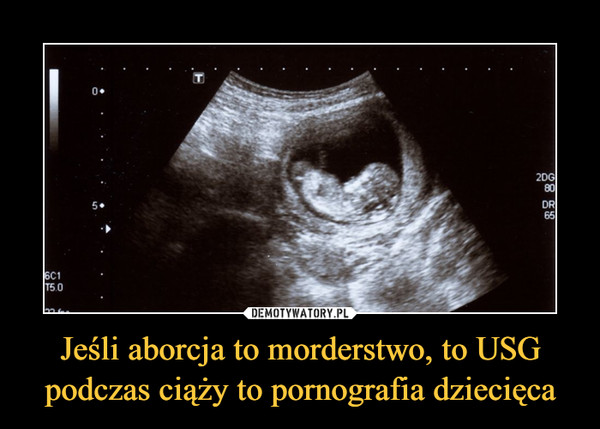Jeśli aborcja to morderstwo, to USG podczas ciąży to pornografia dziecięca