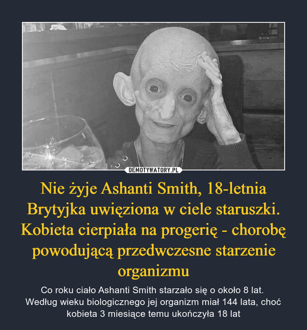 Nie żyje Ashanti Smith, 18-letnia Brytyjka uwięziona w ciele staruszki. Kobieta cierpiała na progerię - chorobę powodującą przedwczesne starzenie organizmu – Co roku ciało Ashanti Smith starzało się o około 8 lat. Według wieku biologicznego jej organizm miał 144 lata, choć kobieta 3 miesiące temu ukończyła 18 lat 
